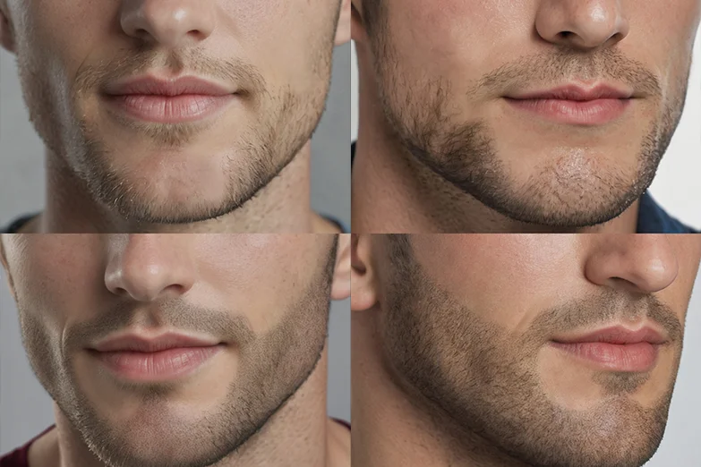 Hair Line services Scalp Micropigmentation