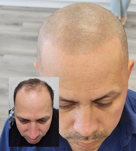 scalp-micropigmentation-melbourne-hair-loss