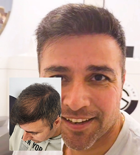 scalp-micropigmentation-melbourne-hairline