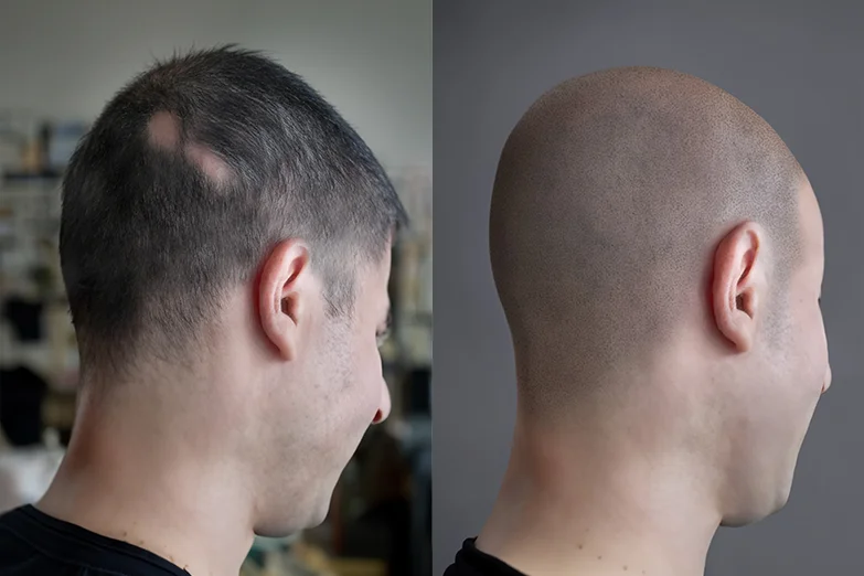 scalp-micropigmentation-alopecia-treatment