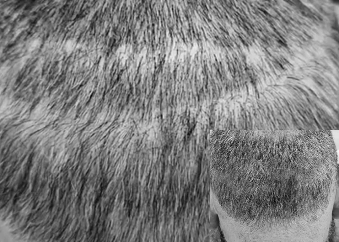 scalp-micropigmentation-hide-transplant-scars