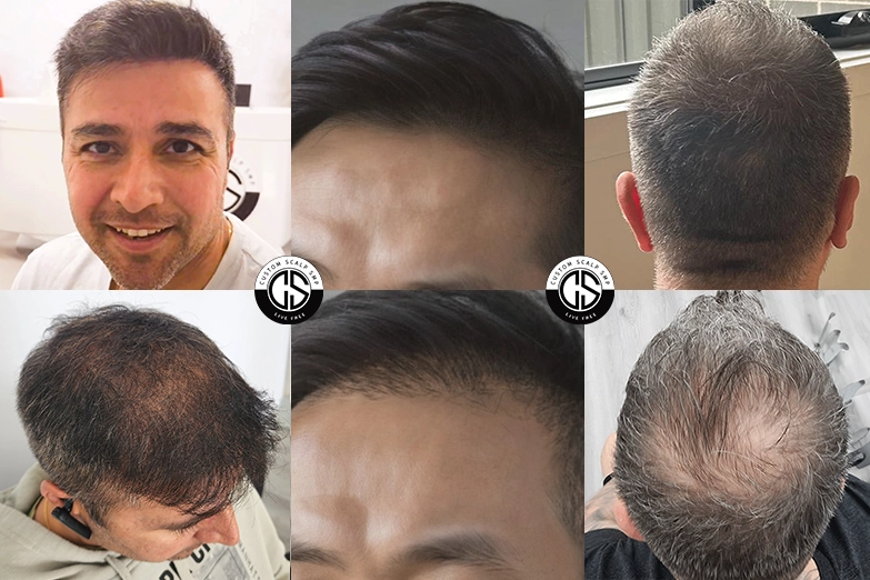scalp-micropigmentation-hair-density