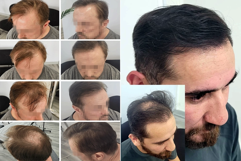 scalp-micropigmentation-hair-density