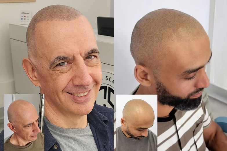 scalp-micropigmentation-hair-loss-solution