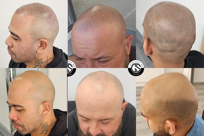 scalp-micropigmentation-hair-loss-treatment