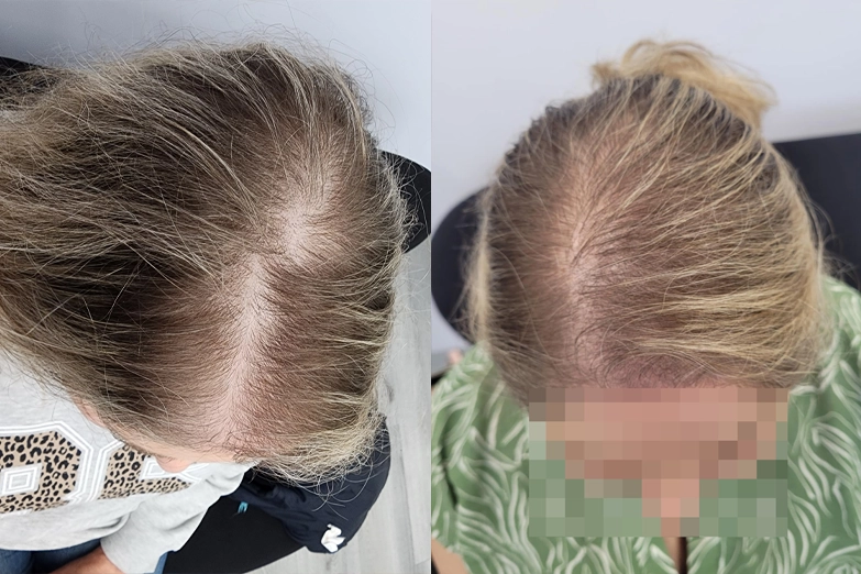 smp-women's-hair-loss-solution